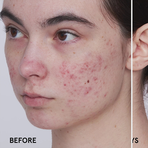 2% salisilik asit Serum İlaçlı akne takas C vitamini AHA hyaluronik asit zerdeçal Anti-Aging anti-kırışıklık yüz - Product Image 6