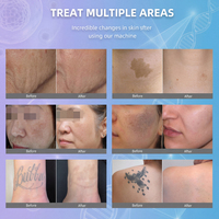 Machine laser picoseconde 3 en 1, Picolaser, élimination des tatouages au laser picoseconde, peeling Hollywood, refroidisseur d'air pour laser picoseconde
