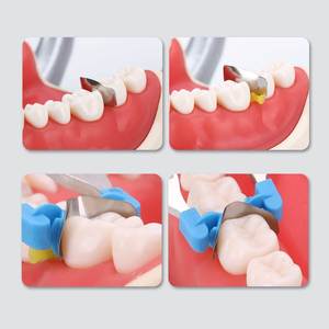 Kit universale di ricambio per denti completi di ricarica in metallo sagomato sezionale a matrice dentale con chiusura a molla - Product Image 3