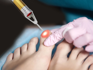 Podólogo Uso Enfermedad del pie 980nm Diodo Láser Onycomicosis Hongo en las uñas Podología Cuidado de las uñas de los pies Podology Máquina antiinflamatoria - Product Image 6