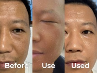 Solution de Peeling Chimique Exfoliant Peau Acide Salicylique Contre l'Hyperpigmentation – Sérum Professionnel Visage et Corps