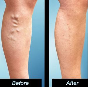 Mesin bedah penghilang Laser endoskopi varises, mesin bedah penghilang Laser 1470nm bergaya laba-laba - Product Image 5