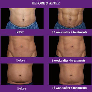 Trushape şekillendirici Flex 3d Mds Trushape güzellik salonu için 2 In 1 Trushape zayıflama Flex kas stimülasyonu - Product Image 6