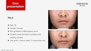 Best Seller Private Label Clinic salone di bellezza usato 5g * 10 tubi Per scatola 35% acidi composti Anti Acne pigmentazione Peeling chimico - Product Image 4