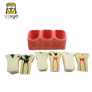 Chất lượng cao 4-lần nha khoa sâu răng phát triển mô hình giảng dạy nha khoa mô hình - Product Image 2