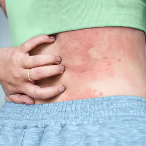 Huile de coco, pommade anti-démangeaisons pour l'urticaire, gel Z Care pour les démangeaisons et les éruptions cutanées - Product Image 3