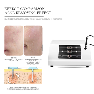 Nuevo Dispositivo de Estética Coreano de Escritorio para Eliminar Puntos Negros, Tratar el Acné y las Cicatrices del Acné con Fines de Belleza - Product Image 4