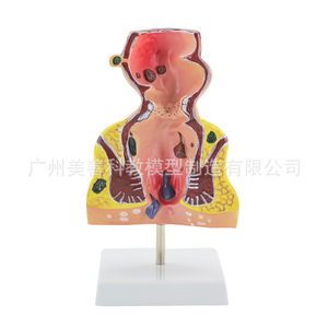 Modèle de hémorroïdes rectales et de lésions colorectales ; hémorroïdes rectales internes et externes et modèle anorectal ; pathologie rectale. - Product Image 3