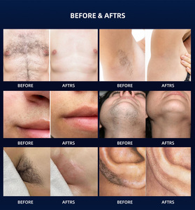 Équipement d'épilation au <span class=keywords><strong>laser</strong></span> 755nm 808nm 1064nm 1200W Dilas Epilator à usage commercial avec écran tactile et refroidissement par eau - Product Image 5