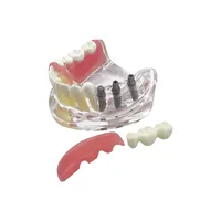 Modelo de Dientes de Mandíbula Inferior Removible con Implante, Restauración de Puente, Modelo de Implante Dental para Educación, Enseñanza, Estudio y Práctica