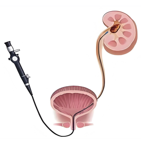 Hd sma905 na 0.22 ऑप्टिक फाइबर होलोमियम लेजर 980 और 1470 दोनों के साथ यूरोलॉजी के लिए - Product Image 2