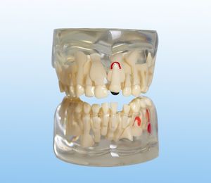 Modelo dental durante el período de dentición alternativa Dentaduras Materiales dentales Modelo de comunicación médico-paciente - Product Image 3