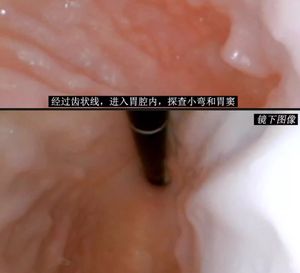 Modelo de Decúbito Lateral Gastrointestinal de Alta Calidad para Entrenamiento en Cirugía Gastroscópica, Modelo de Endoscopia - Product Image 6