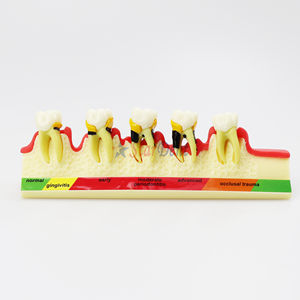 Odontologia Modelo De Educação De Dentes De Doença <span class=keywords><strong>Periodontal</strong></span> Para Treinamento Modelo De Doença <span class=keywords><strong>Periodontal</strong></span> Dentária - Product Image 3