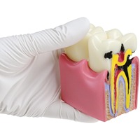 Modèle d'anatomie dentaire multifonctionnel éducatif de caries, section transversale agrandie 6X, en résine, pour l'enseignement et la santé dentaire