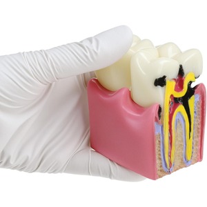 Modelo Educativo de Caries Dentales, Ampliado 6 Veces en Sección Transversal, Material de Resina para Educación Anatómica y Enseñanza de Salud Dental - Product Image 4