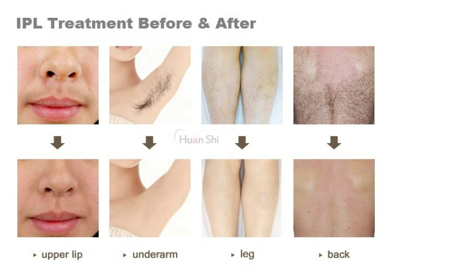 2 en 1 Nd Yag Laser/máquina de eliminación de tatuajes portátil Ipl Hair Removal Laser