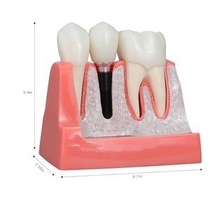 4 Times Medical Science Education Studying Dental Implant Model Removable <b>Teeth</b> Multi-Purpose <b>Teeth</b> <b>Whitening</b> Accessories - Product Image 5
