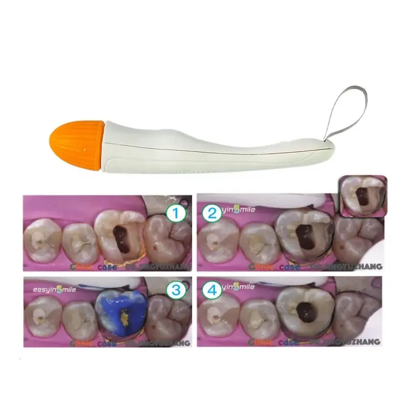 10 Bandes Matricielles Profilées Easyinsmile – Pour Restaurations Dentaires Pro