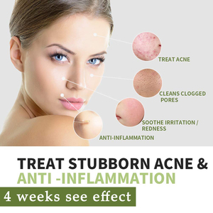 Krim Perawatan Bekas Jerawat <span class=keywords><strong>Herbal</strong></span> Organik Terbaik Label Pribadi - Product Image 2