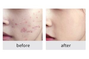 เซรั่มซ่อมแซมสิวแบบพรีเมี่ยมครีมบำรุงผิวแบบน้ำกรดซาลิไซลิกสำหรับผิวแพ้ง่าย - Product Image 2