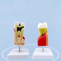 Modèle d'anatomie dentaire complet : Profil de pathologie de la carie dentaire – Produit scientifique médical