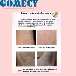 Equipo de Belleza Profesional <span class=keywords><strong>con</strong></span> Láser de Diodo de 980nm y 1470nm, 6+1 Panacea para Disolver Grasa, <span class=keywords><strong>Eliminar</strong></span> Vasos Sanguíneos y Endolifting - Product Image 4