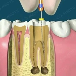 Foshan Meite tập tin endo nha khoa niti tập tin quay endo tập tin quay với chứng chỉ CE/ISO - Product Image 4
