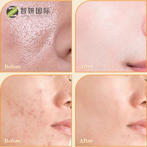 Nhãn Hiệu Riêng Hữu Cơ Nghệ Chống Mụn Trứng Cá Làm Trắng Mặt Chăm Sóc Nhẹ Nhàng Tạo Bọt Da Rửa Mặt Làm Sạch Mousse - Product Image 4