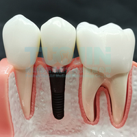Modèle d'implant dentaire, couronne, pont, modèle amovible, modèle de dents en porcelaine, modèle de démonstration dentaire pour l'enseignement des dentistes