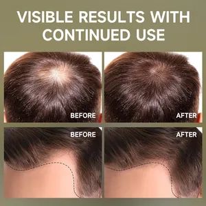 2025 Bán hàng nóng tăng trưởng tóc đỏ hành tây dầu hạt đen điều trị da đầu chống tóc mùa thu hành tây đỏ Volumizing tóc mọc lại dầu - Product Image 6