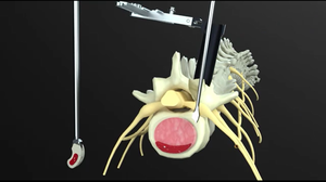 Perangkat Fusi <span class=keywords><strong>Interbody</strong></span> Lumbar Ortopedi Posterior Kelas III Berlabel CE Fule, Garansi Lebih Dari 5 Tahun, Material PEEK - Product Image 3