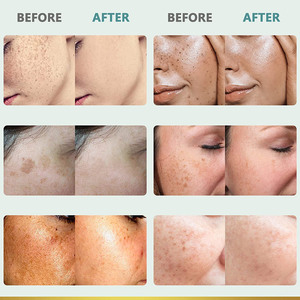 Crema Blanqueadora para Pecas, Eliminador de <span class=keywords><strong>Manchas</strong></span> Oscuras y Melasma, Anti-<span class=keywords><strong>Manchas</strong></span> Marrones, Aclara la Pigmentación, Hidratante, Cuidado de la Piel, Productos Coreanos - Product Image 6
