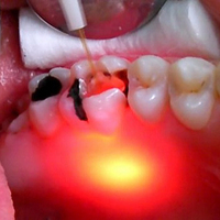 Équipement dentaire portable à diode laser de faible puissance 30 W, machine de blanchiment des dents au laser 980 nm