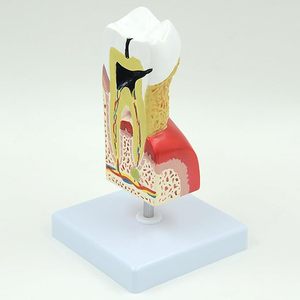 PVC đào tạo nha khoa con người bệnh lý răng sâu răng Mở rộng giải phẫu chính xác mô hình sâu răng cho các bài thuyết trình nha khoa - Product Image 3