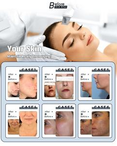 Professional 15-in-1 Aqua Peeling & Microdermabrasion Machine for Face & Eyes Hydra Oxygen Facial Spa Treatment - Product Image 3