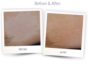 Traitement au laser excimer UVB 308 nm pour le vitiligo et le psoriasis, <span class=keywords><strong>solution</strong></span> hautement efficace de luminothérapie ultraviolette Kernel 2025 - Product Image 6