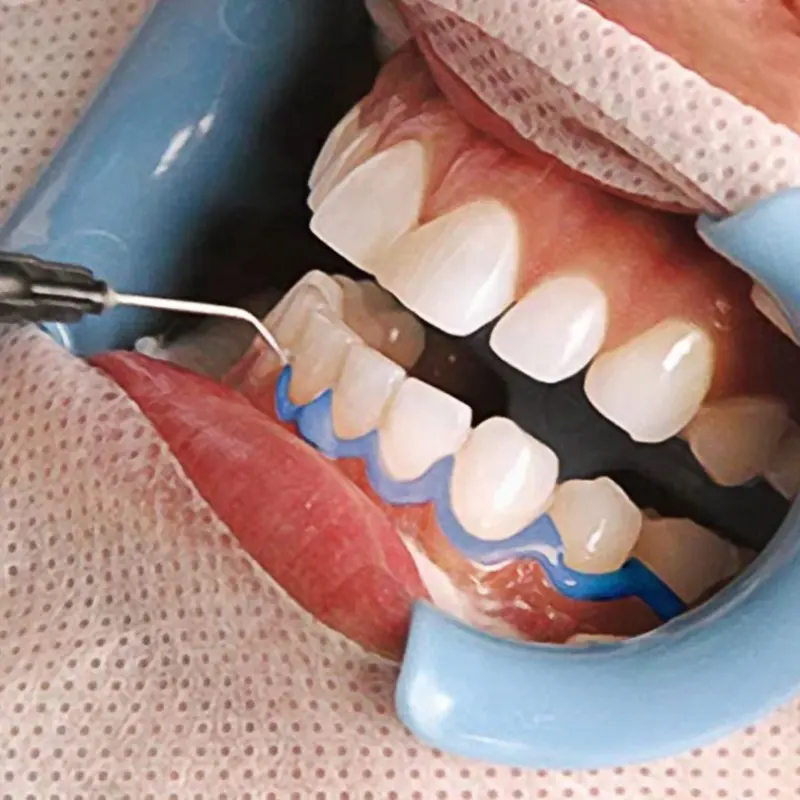 1.5ml 3ml Gingival Barrier - Gum Protection Gel für Teeth Whitening Treatment