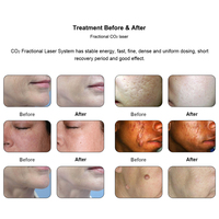 Fractional-co2-laser rapide de rajeunissement de peau de traitement de laser partiel compact d'équipement de dermatologie d'agent