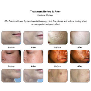 Fractional-co2-<span class=keywords><strong>laser</strong></span> rapide de rajeunissement de peau de traitement de <span class=keywords><strong>laser</strong></span> partiel compact d'équipement de <span class=keywords><strong>dermatologie</strong></span> d'agent - Product Image 5
