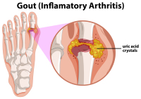 Thé Équilibre Acide Urique Sachet Tisane Anti-Arthralgie Santé à Base de Plantes