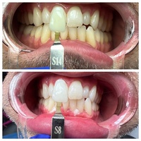 Gel blanchissant professionnel pour les dents au peroxyde d'hydrogène 35% de qualité dentaire, double applicateur, catalyseur 5ml, mélange 4:1, pour usage commercial