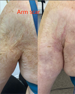 Máquina de Láser Fraccional de <span class=keywords><strong>CO2</strong></span> de 10600nm con Certificación CE para Eliminación de Cicatrices de Acné y Rejuvenecimiento de la Piel - Product Image 5