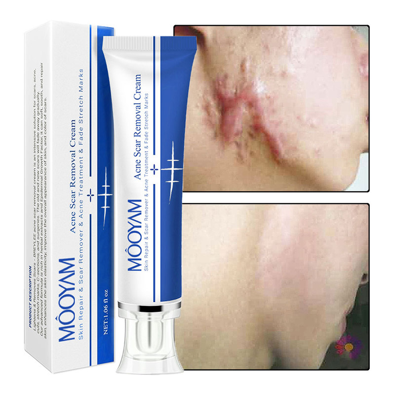 Best Stretch Marks Remover Oil with