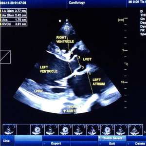 Ecocardiografie Kleur <span class=keywords><strong>Doppler</strong></span> Scan Cw Draagbare 128 Elementen Echografie Machine - Product Image 5