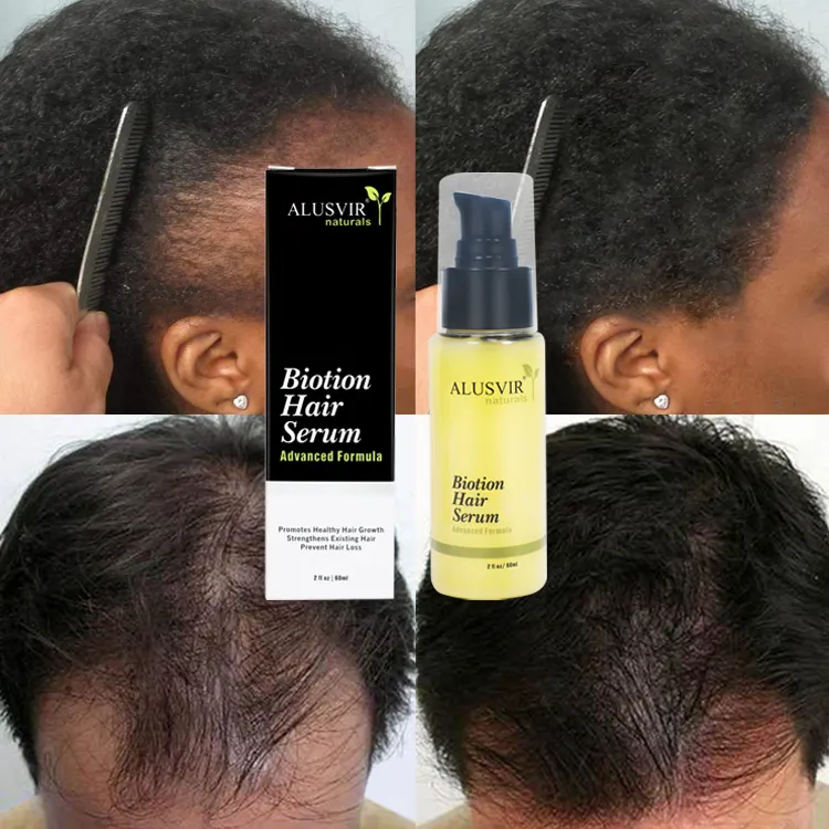 I prodotti per la cura dei capelli con siero per la crescita dei capelli con biotina Oem coltivano un trattamento rapido e sano per la perdita dei capelli per uomini e donne
