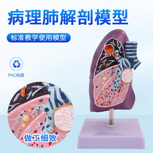 Modelo de pulmón humano, modelo de anatomía patológica del pulmón, sistema respiratorio, modelo de órgano humano, modelo de pulmón enfermo - Product Image 2