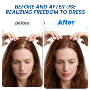 Crema Sumifun para el Crecimiento del Cabello y el Cuidado de la Piel de la Cabeza, para la <span class=keywords><strong>Alopecia</strong></span> <span class=keywords><strong>Areata</strong></span> - Product Image 2