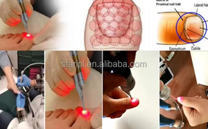 <span class=keywords><strong>Tratamiento</strong></span> para Hongos en las Uñas, Láser de 980nm para Eliminar Hongos en los Dedos, Verrugas <span class=keywords><strong>Plantares</strong></span>, Podología, Eliminación de Venas, Onicomicosis, Láser de Diodo - Product Image 3