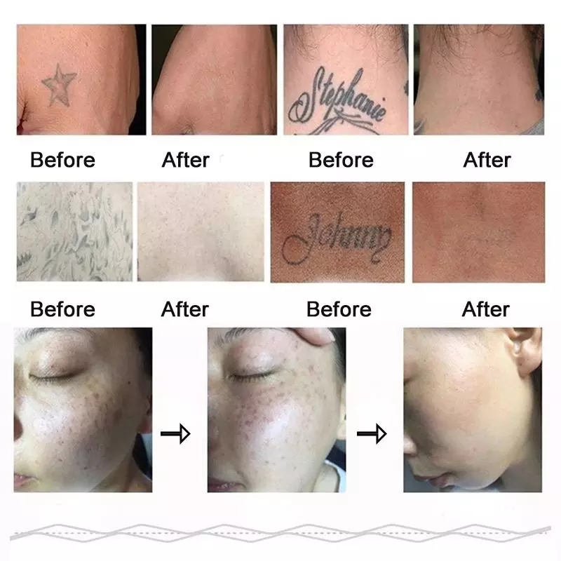 Stand 2 in 808nm diode hair removal and nd yag laser tattoo removal machine